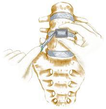 Anterior Lumbar Interbody Fusion (ALIF)