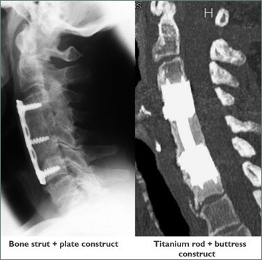 Cervical Corpectomy