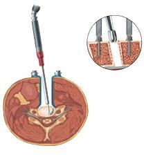 prestige cervical disc surgery