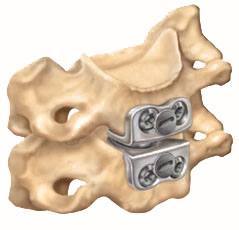 prestige cervical disc surgery