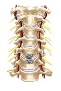 prestige cervical disc surgery