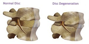 Disc Degeneration