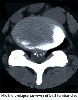 Lumbar Microdiscectomy