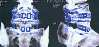 Posterior Lumbar Interbody Fusion (PLIF)