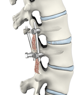 Spinal Fusion