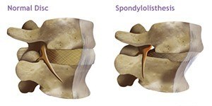 Spondylolisthesis