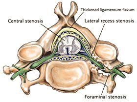 Lumbar Laminectomy