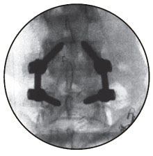 Transforaminal Lumbar Interbody Fusion (PLIF)