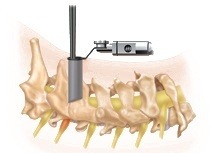 Cervical Foraminotomy